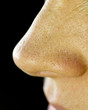 Nose Blackheads Nose Blackheads