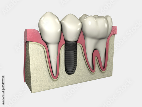Illustration: Implante 3D Colocado 01 Implante 3D Colocado 01