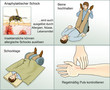 Anaphylaktischer Schock.Erste Hilfe Anaphylaktischer Schock.Erste Hilfe