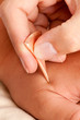 Macro Detail of Yoneyama Acupuncture Tool