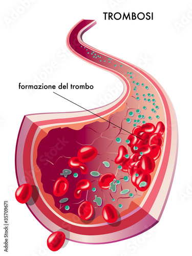 Vector: Trombosi Trombosi