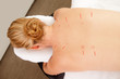 Back Shu Acupuncture Points
