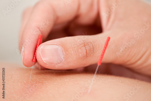 Photo: Acupuncture Macro Acupuncture Macro
