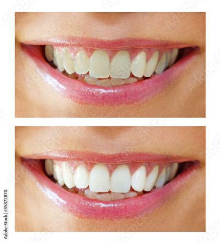 Photo: Bleaching effect Bleaching effect