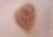 Ecchymose (bleu)