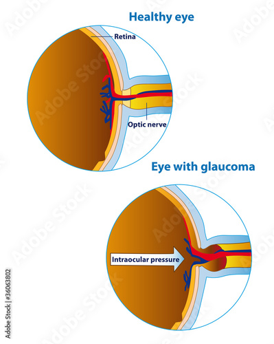 Vector: Glaucoma Glaucoma