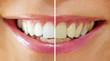 Bleaching Effect - befor & after Bleaching Effect - befor & after