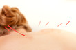 Photo: Acupuncture on Back Shu Points Acupuncture on Back Shu Points