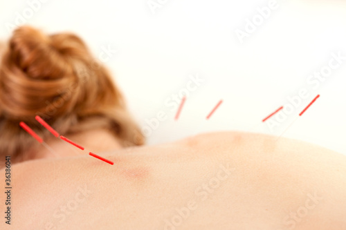 Photo: Acupuncture on Back Shu Points Acupuncture on Back Shu Points