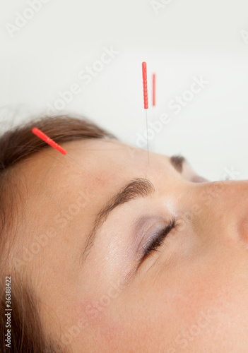 Photo: Facial Acupuncture Facial Acupuncture