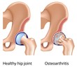 Osteoarthritis of hip joint, eps8