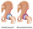 Rheumatoid arthritis of hip joint, eps8