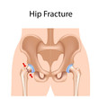 Hip fracture, eps8