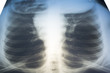 Women's chest x-ray recording