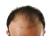 Foto: Man loosing hair, baldness Man loosing hair, baldness