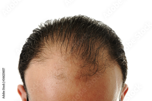 Photo: Man loosing hair, baldness Man loosing hair, baldness