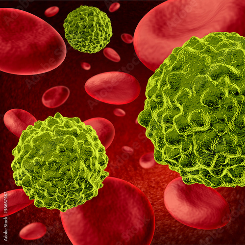 Illustration: Human cancer Human cancer