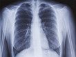 Radiographie de poumons