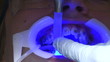 Vídeo : curing the orthodontic glue with UV light curing the orthodontic glue with UV light