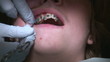 Vídeo : Fixing a bite corrector Fixing a bite corrector