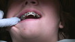 Vídeo : checking the bite corrector position checking the bite corrector position