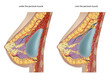 Plastic surgery of breast implants. Vector