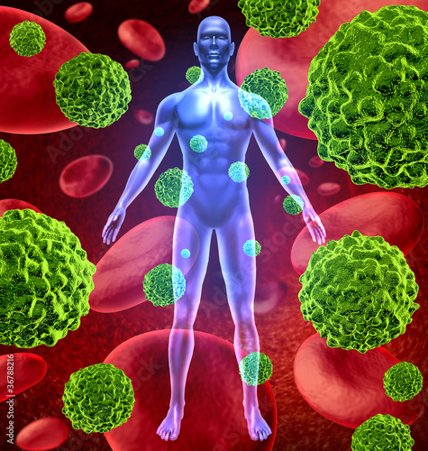 Illustration: Human body with cancer cells spreading and growing Human body with cancer cells spreading and growing