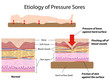 Etiology of pressure sores, eps8