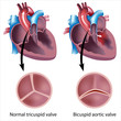 heart valve defect, eps8