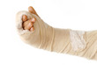 Photo: Broken arm Broken arm