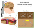 Brain trauma with axon shear, eps8