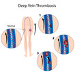 Deep vein thrombosis, eps8