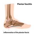 Plantar fasciitis, foot problem, eps8