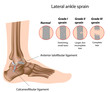 Ankle sprain grading, eps8