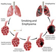 Smoking and Emphysema, eps8