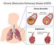 Chronic obstructive pulmonary disease, eps8