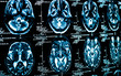 Closeup of a computer axial tomography scan (CAT scan)