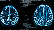 Closeup of a computer axial tomography scan (CAT scan)