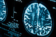 Closeup of a computer axial tomography scan (CAT scan)