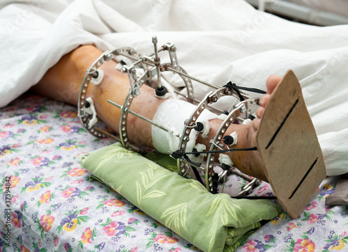 Photo: leg in Ilizarov's external fixator, Ilizarov's apparatus leg in Ilizarov's external fixator, Ilizarov's apparatus