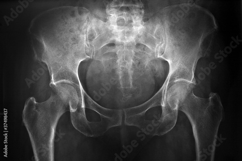 Photo: radiografia del bacino radiografia del bacino