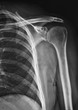 radiografia della spalla