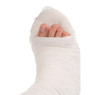 leg in a plaster cast leg in a plaster cast