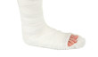 leg in a plaster cast leg in a plaster cast