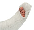 leg in a plaster cast leg in a plaster cast