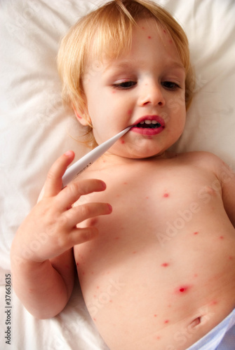 Photo: Chicken Pox Baby Chicken Pox Baby