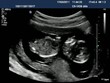 Echographie bébé