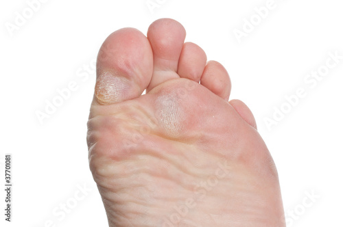 Photo: Callus on toes Callus on toes