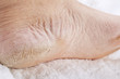 Feet that need a pedicure