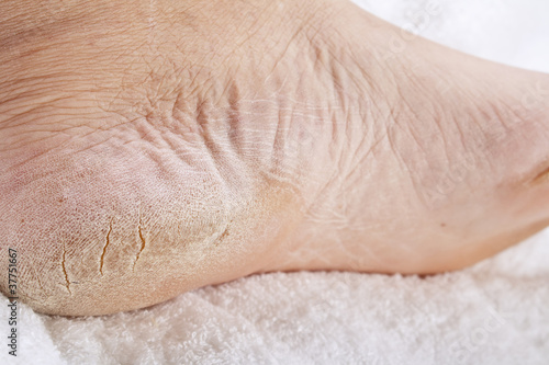 Photo: Feet that need a pedicure Feet that need a pedicure